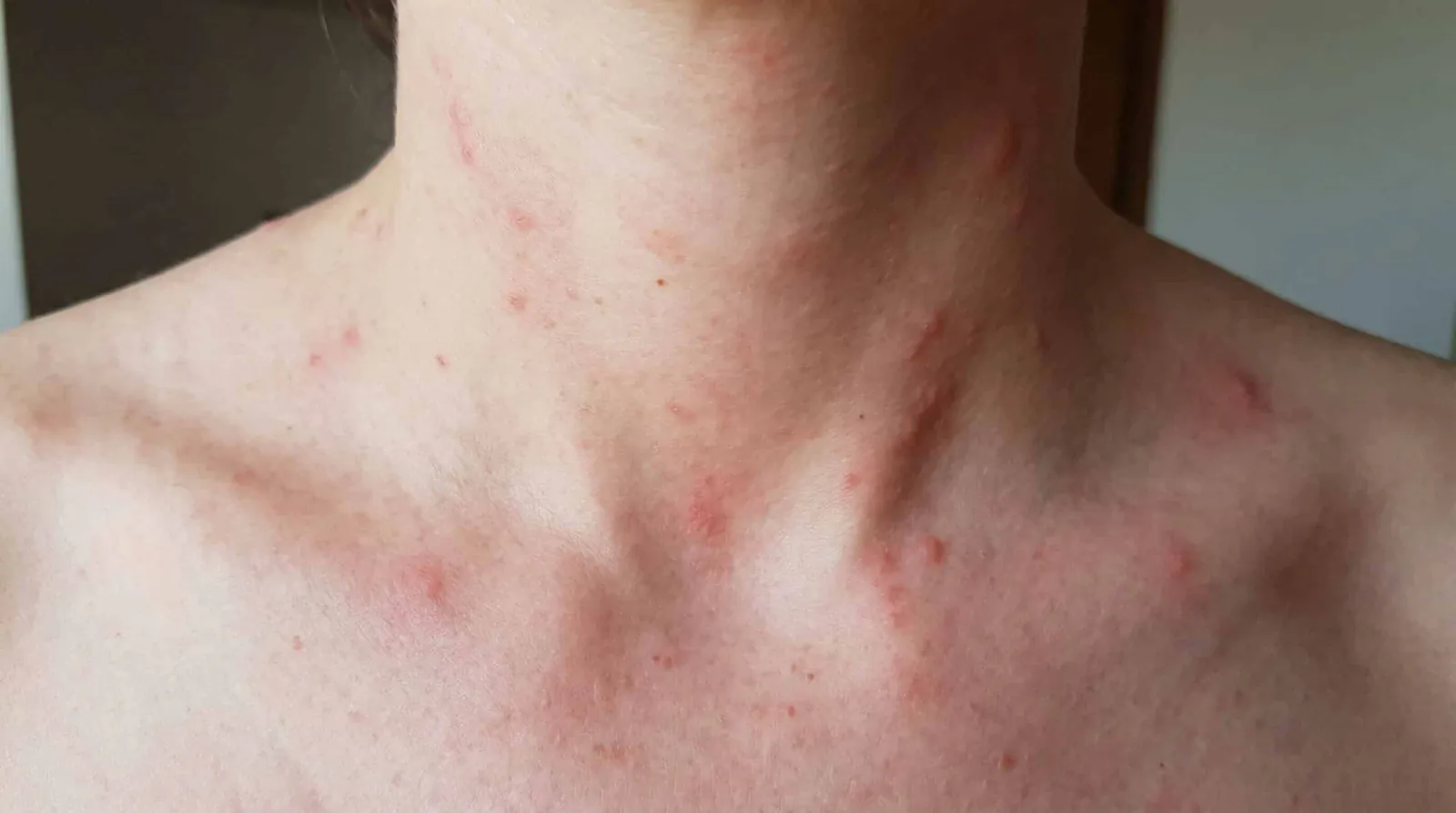 Scleroderma domesticum: come liberarsene riducendo il rischio di punture
