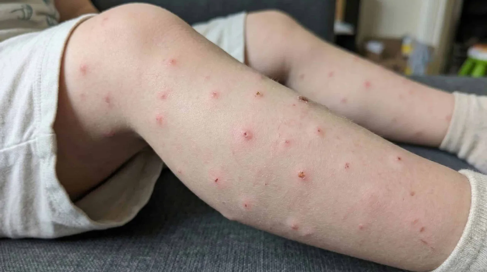 Strofulo: cos’è, come riconoscerlo e quando può dipendere da punture di insetti
