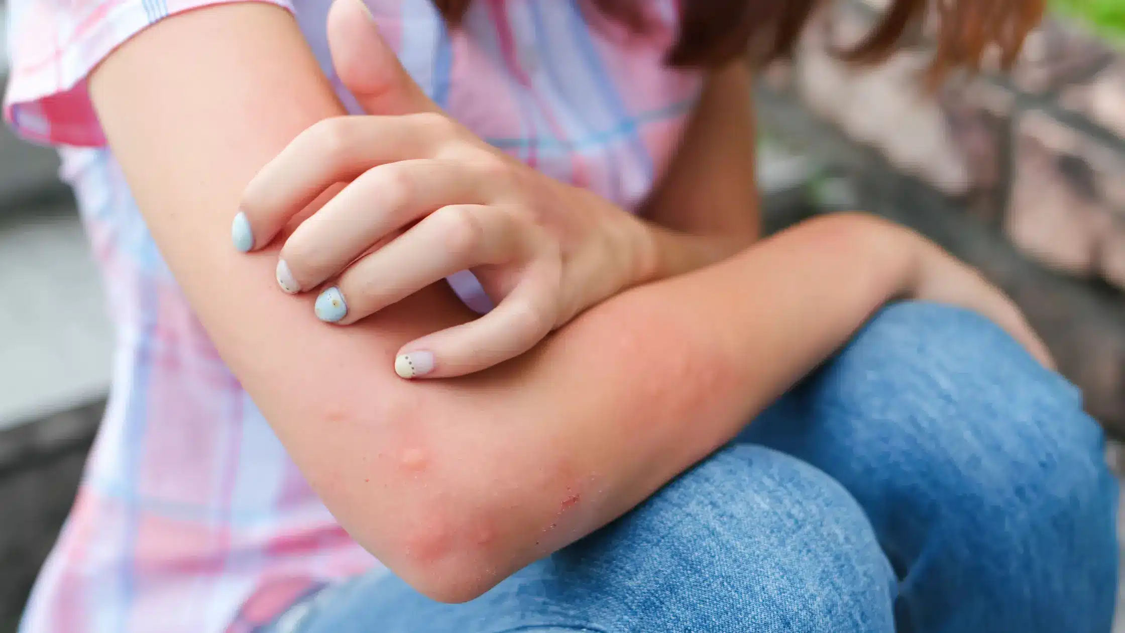 West Nile: sintomi, trasmissione e prevenzione del virus delle zanzare